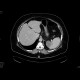 Splenic infarction: CT - Computed tomography